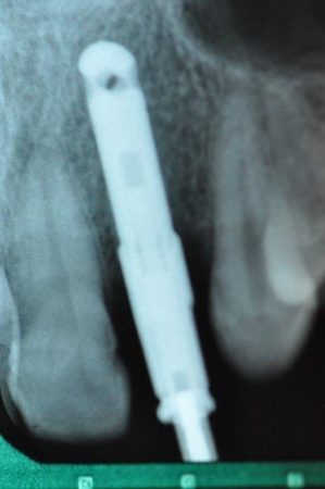 2-implant-xray