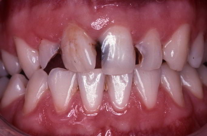 Tooth cavities