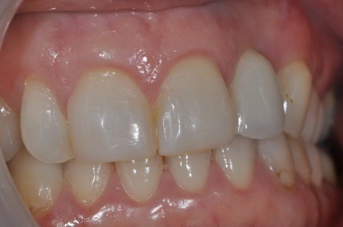 implant-after