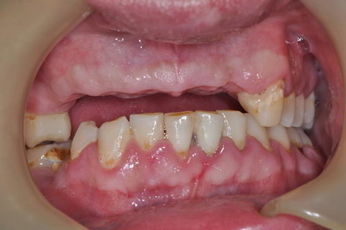 Before Denture