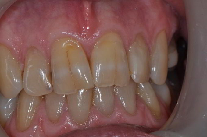 pre-composite-veneers