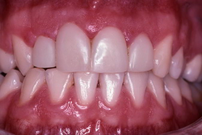 Tooth coloured fillings