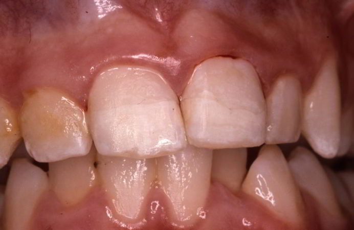 Tooth Trauma after-treatment