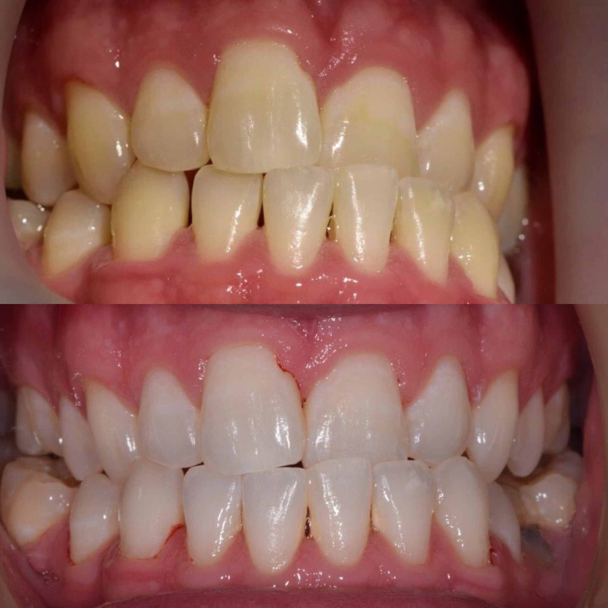 How long after zoom teeth whitening can i drink coffee
