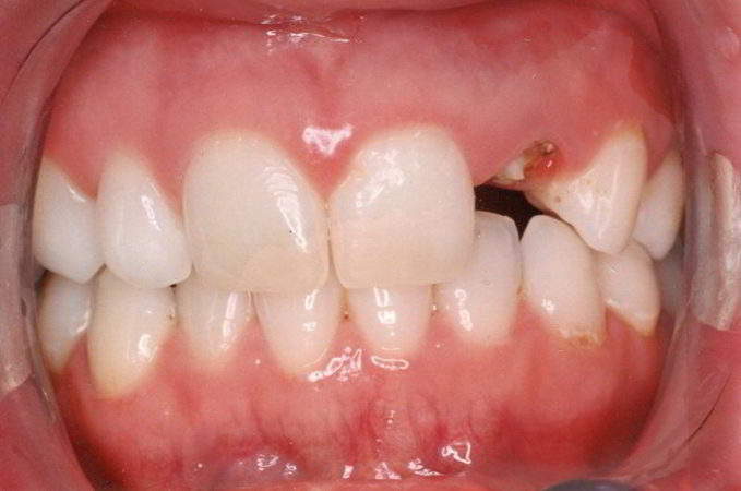 broken-tooth-pre-implant