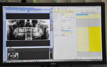 Dental-xray-results