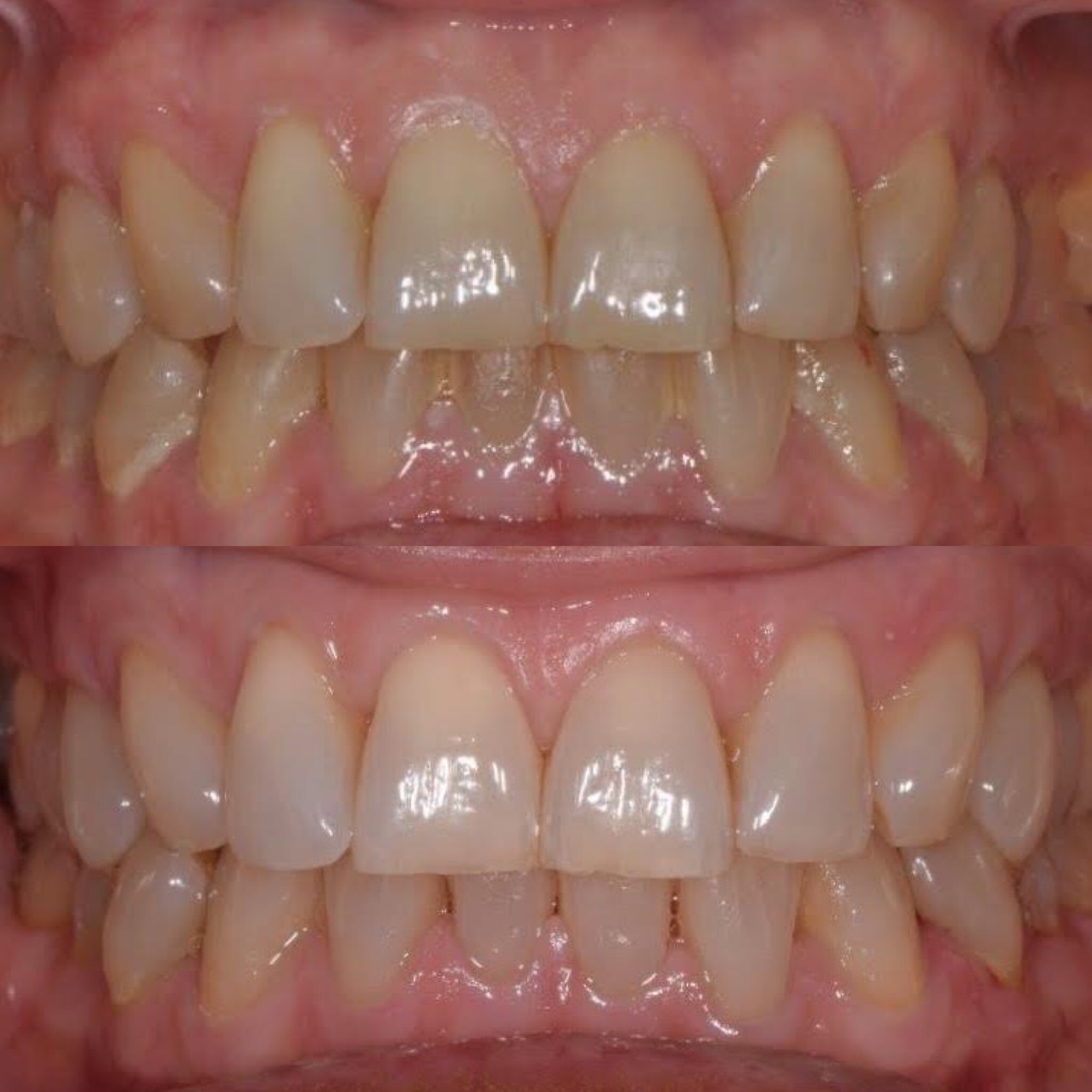 whitening